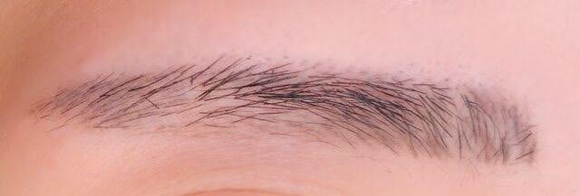 1年後、部分的に薄くなった右眉の写真