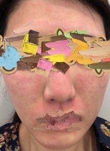 ダーマペン4施術直後の肌の様子を写した実際の写真(目元と口元はスタンプで加工)