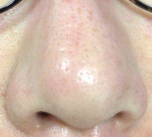 ダーマペン4施術直後の鼻の毛穴とニキビ跡の状態がわかるアフター写真