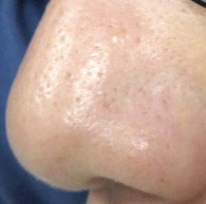 ダーマペン4施術直後の鼻の毛穴とニキビ跡の状態がわかるアフター写真