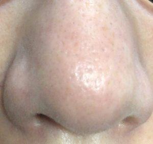 ダーマペン4施術二週間後の鼻の毛穴とニキビ跡の状態がわかるアフター写真