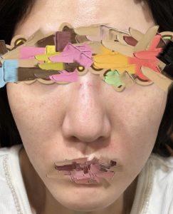 ダーマペン4施術翌日の肌の様子を写した実際の写真(目元と口元はスタンプで加工)