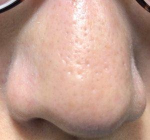 ダーマペン4施術前の鼻の毛穴の状態。開きや黒ずみが目立っている様子（正面）