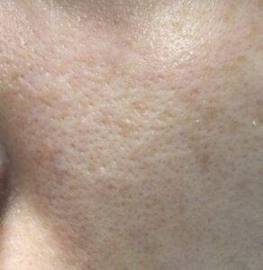 ダーマペン4施術前の頬の毛穴の状態。開きや黒ずみが目立っている様子（左側）