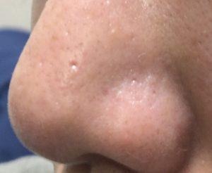 ダーマペン4施術前の鼻の毛穴の状態。開きや黒ずみが目立っている様子（左側）