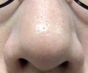 ダーマペン4施術前の鼻の毛穴の状態。開きや黒ずみが目立っている様子（下から）