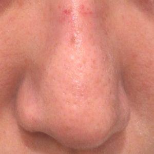 ダーマペン4施術直後の鼻まわりの赤みと腫れの様子（正面）