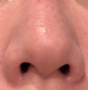 ダーマペン4施術直後の鼻まわりの赤みと腫れの様子（下から）