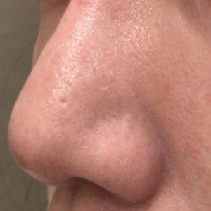 ダーマペン4施術直後の鼻まわりの赤みと腫れの様子（左側）