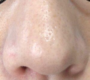 ダーマペン4を2回施術した鼻まわりの毛穴の様子（正面）