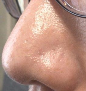 ダーマペン4を3回施術した鼻まわりの毛穴の様子。以前より凹凸が軽くなった状態。（左側）