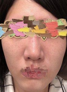 ダーマペン4施術三日後の肌の様子を写した実際の写真(目元と口元はスタンプで加工)