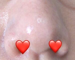 ダーマペン4を4回施術した鼻まわりの毛穴の様子。ツルツルになってきている状態。（下から）