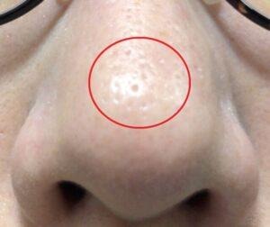 ダーマペン4を施術するビフォーの写真。毛穴の開きや黒ずみが目立っている写真（下から）