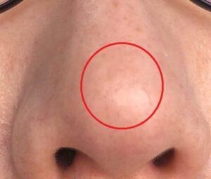 ダーマペン4を5回受けて毛穴の凹凸が軽減された様子。（下から）