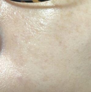 ダーマペン4を5回受けて毛穴の凹凸が軽減された様子。（左側の頬）