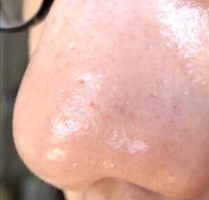 ダーマペン4を4回施術した鼻まわりの毛穴の様子。ツルツルになってきている状態。（左側）