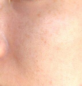 ダーマペン4を4回施術した頬の毛穴の様子。ツルツルになってきている状態。（左側）