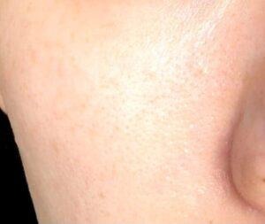 ダーマペン4を4回施術した頬の毛穴の様子。ツルツルになってきている状態。（右側）