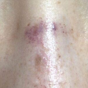 ダーマペン4を4回施術した鼻の様子。内出血している。