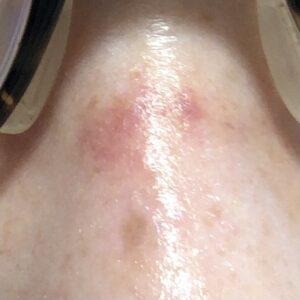 ダーマペン4を4回施術した鼻の様子。内出血しているが、2日後には薄くなっている。