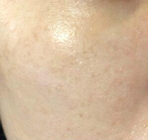 ダーマペン4を5回受けて毛穴の凹凸が軽減された様子。（右側の頬）