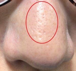 ダーマペン4を施術するビフォーの写真。毛穴の開きや黒ずみが目立っている写真（正面）