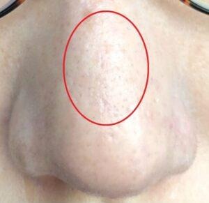 ダーマペン4を5回受けて毛穴の凹凸が軽減された様子。（正面）