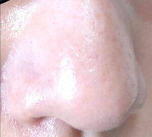 ダーマペン4を4回施術した鼻まわりの毛穴の様子。ツルツルになってきている状態。（正面）